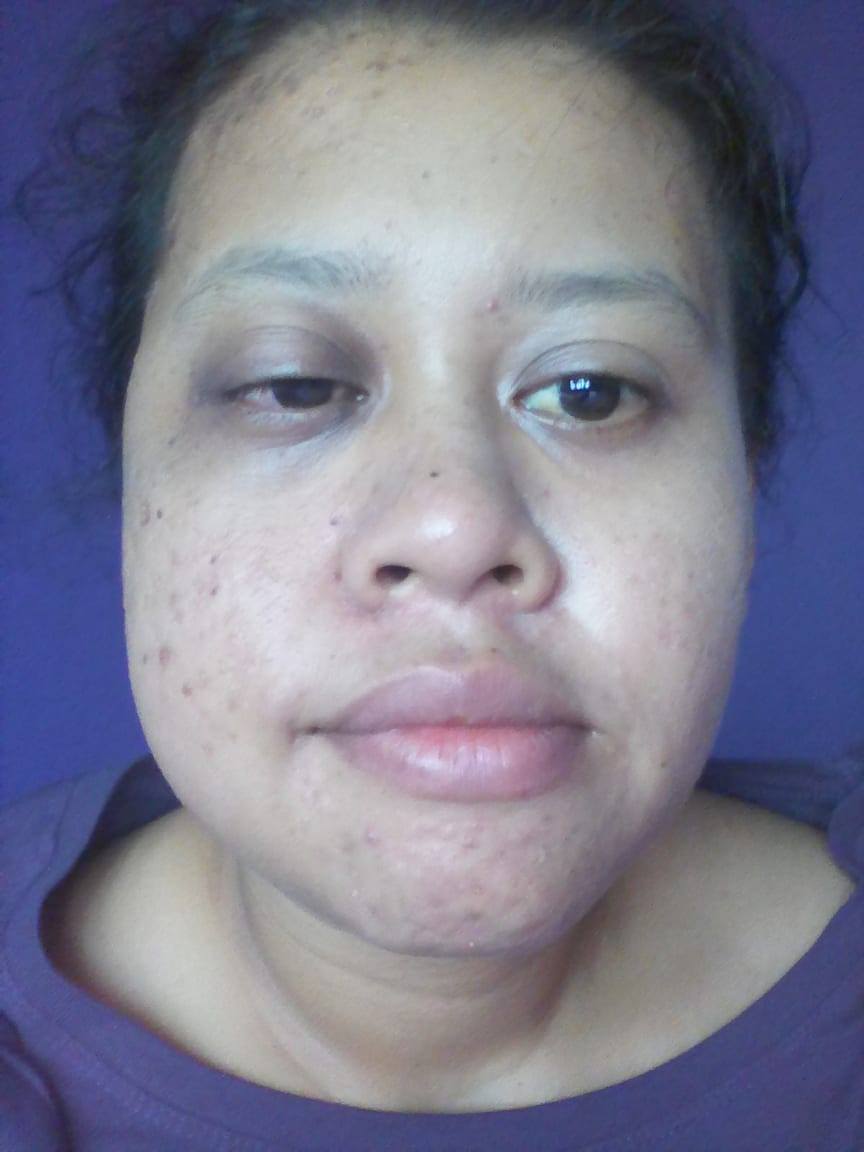 Menderita KANSER HIDUNG Selepas Berpantang, Wanita Ini 